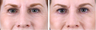 Botox Cosmetic