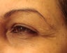 Botox