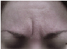 Botox