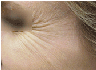 Botox