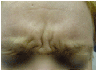 Botox