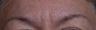 Botox