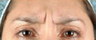 Botox
