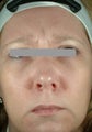 Botox