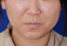 Botox Facial Contouring/Jawline Reduction