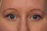 Botox to Crows Feet and Between Eyes (Glabella)
