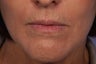Botox and Juvederm Ultra Plus to Upper Lip