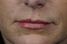 Botox 