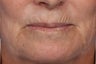 Botox and Juvederm 