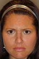 Dysport / Botox