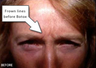Botox - Glabella