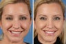 Botox Cosmetic & Restylane