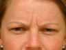 Botox Cosmetic