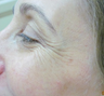 Botox