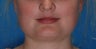 Botox for enlarged jaw muscles