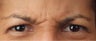 Botox