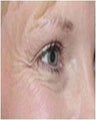 Botox