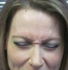Botox