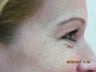 Botox for crow's feet