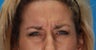 Botox
