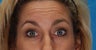Botox