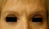 Botox & Restylane - Glabella 
