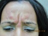 Botox for Frown Lines