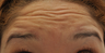 Botox