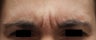 Frown Lines
