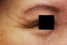 Crow's feet wrinkles