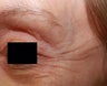 Crow's feet wrinkles