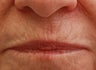 Upper Lip (whistle) lines