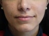 Botox Jawline Reduction