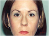 Botox