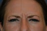 Botox injected in between the eyebrows and into the forehead