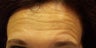 Botox Injections