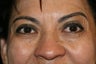 Botox