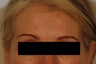 Coreecting Asymmetry with Botox (Dysport Browlift). 