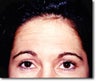 BOTOX 