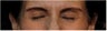 Botox
