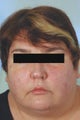 Botox and Restylane for Mouth Frown