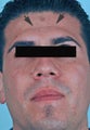 Botox treatment for forehead
