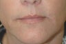 Lip enhancement (smoker's lines)