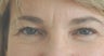Botox forehead lines (frown lines) 