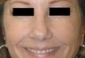 Botox for Crows Feet 