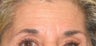 Botox Treatment for Forehead and Brow Wrinkles