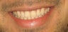 Braces used to correct crowding and bite