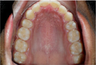 Braces