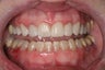 Short Term Orthodontics aka "6 Month Smiles"
