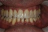 Braces